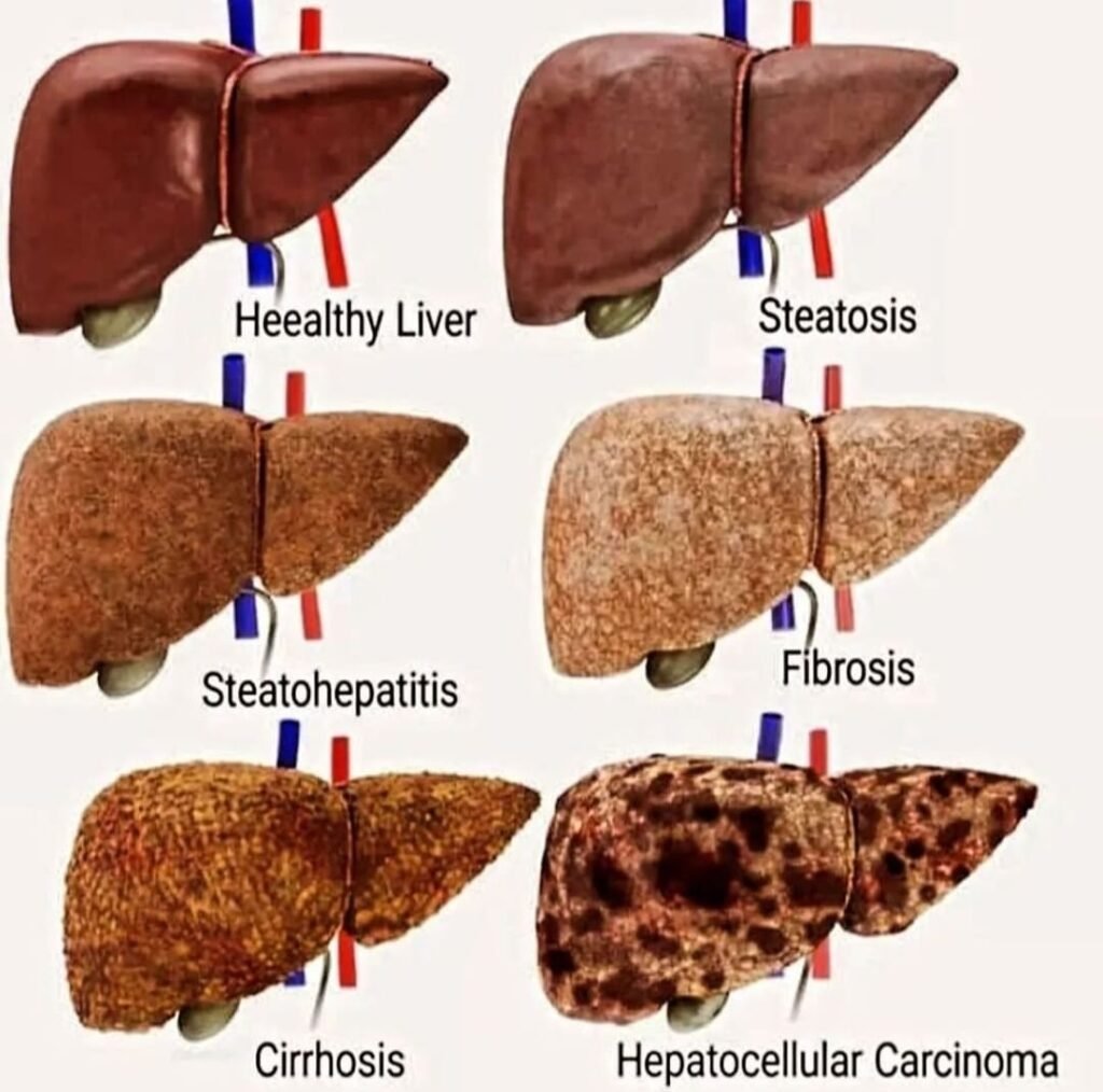  Harmful Liver Disease