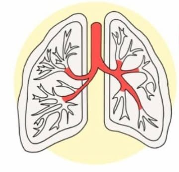 Bronchitis: