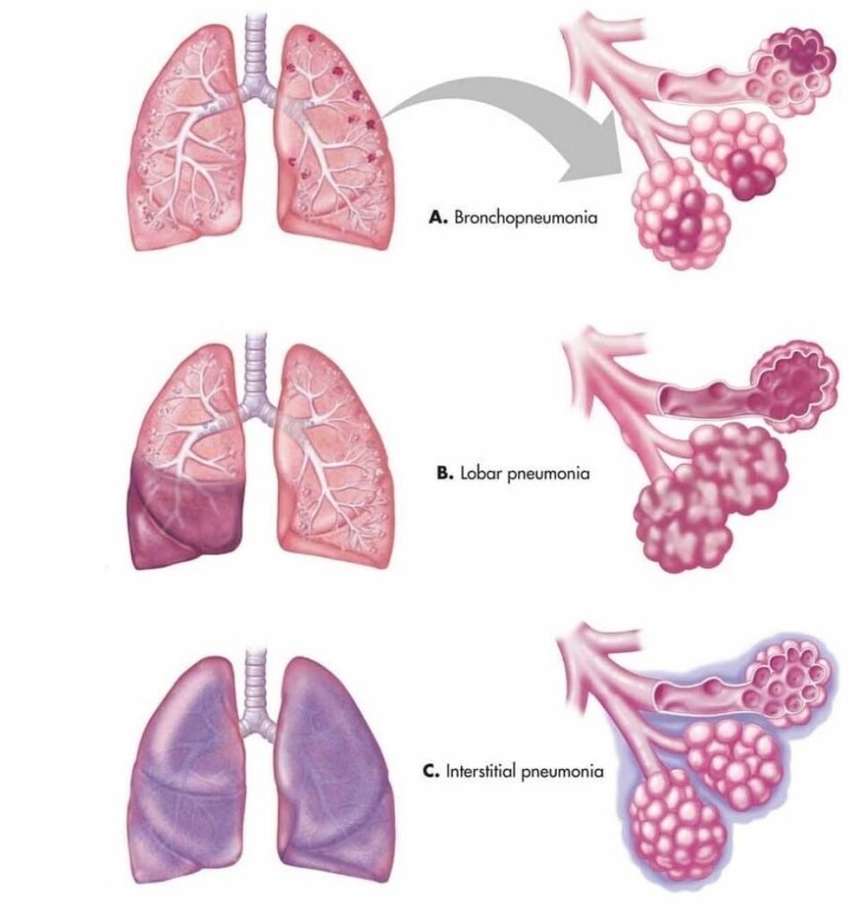 Pneumonia And Bronchitis can Dangerous